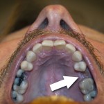 Tooth01 05-10-12 lo-res The infected tooth in question