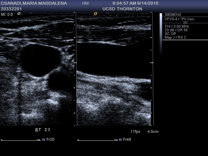 Mami’s Followup Blood Clot Ultrasound PAC's Worlds